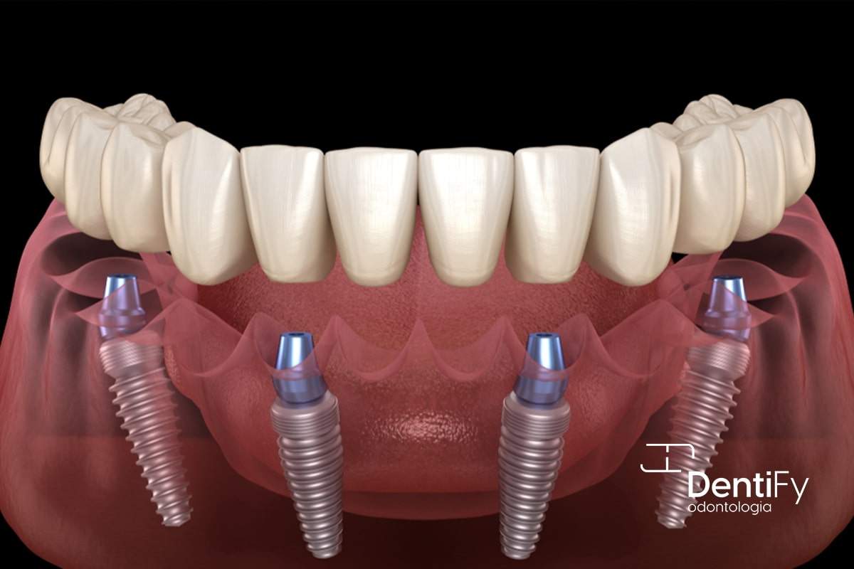 PROTESE-PROTOCOLO-3